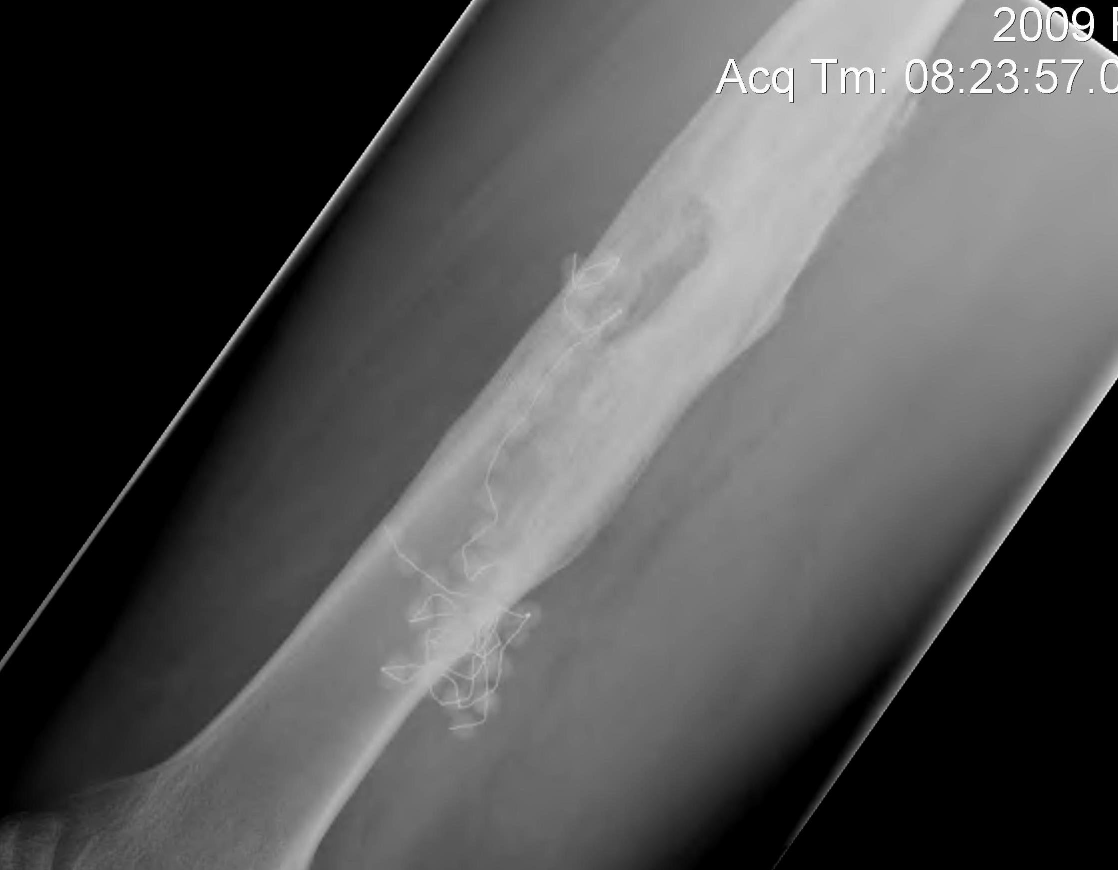 Chronic Osteomyelitis Femur Lateral